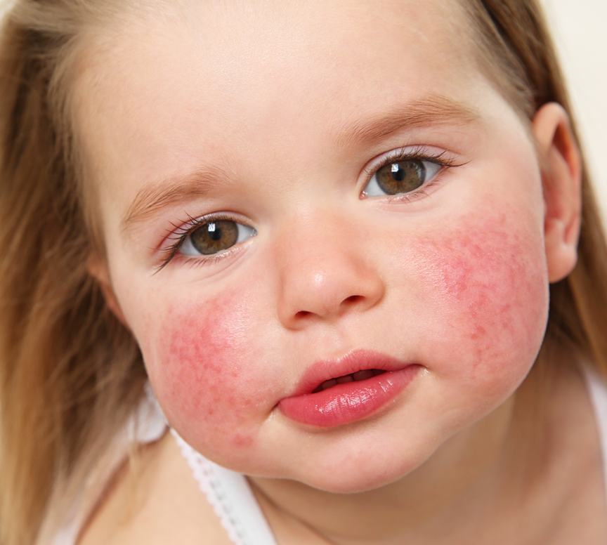 Close-up of skin affected by atopic dermatitis or eczema