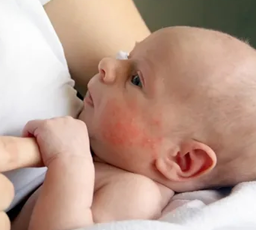 Dermatologist examining patient with atopic dermatitis rash