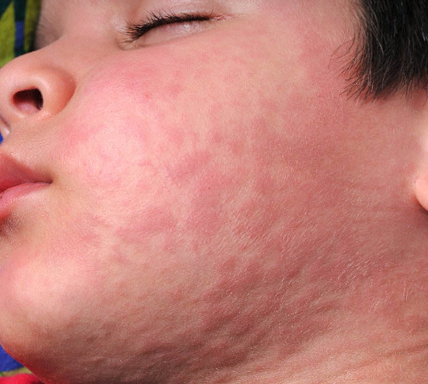 Dermatologist examining patient with urticaria rash