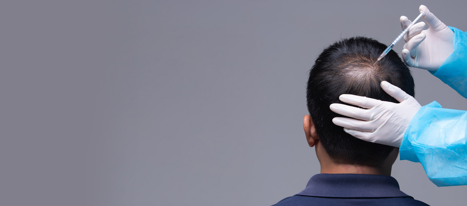Mesotherapy and exosome therapy for hair thinning and baldness