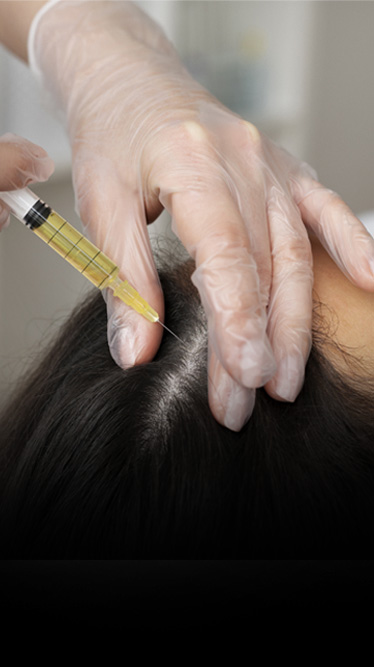 Specialized hair loss treatment for alopecia and pattern baldness in Kerala