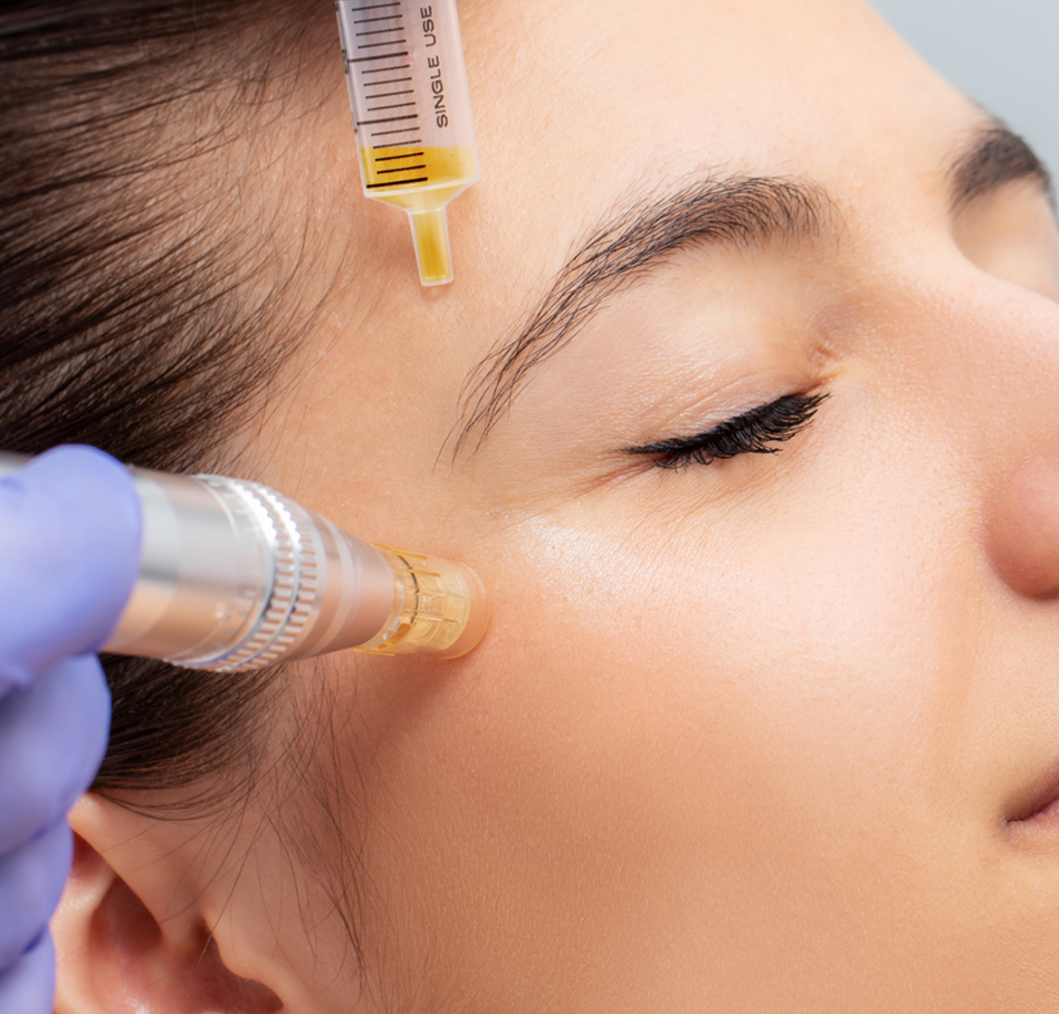Effective acne and pimple control treatments in Kochi