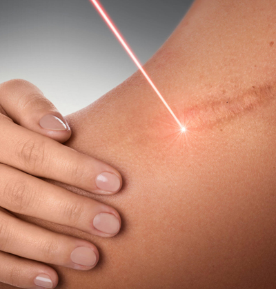 Advanced scar revision surgery to improve appearance of facial scars