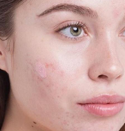 Dermatologist performing acne surgery at Skinpal Clinic Kochi