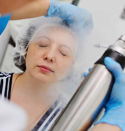 Cryosurgery procedure using liquid nitrogen for wart and mole removal