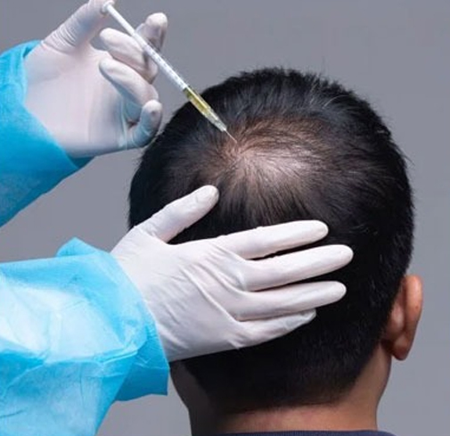 GFC treatment for hair regrowth and scalp rejuvenation in Kochi