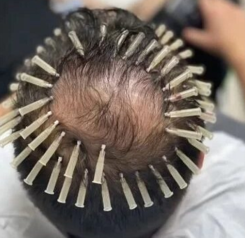 Scalp thread therapy to stimulate hair follicles and improve hair density