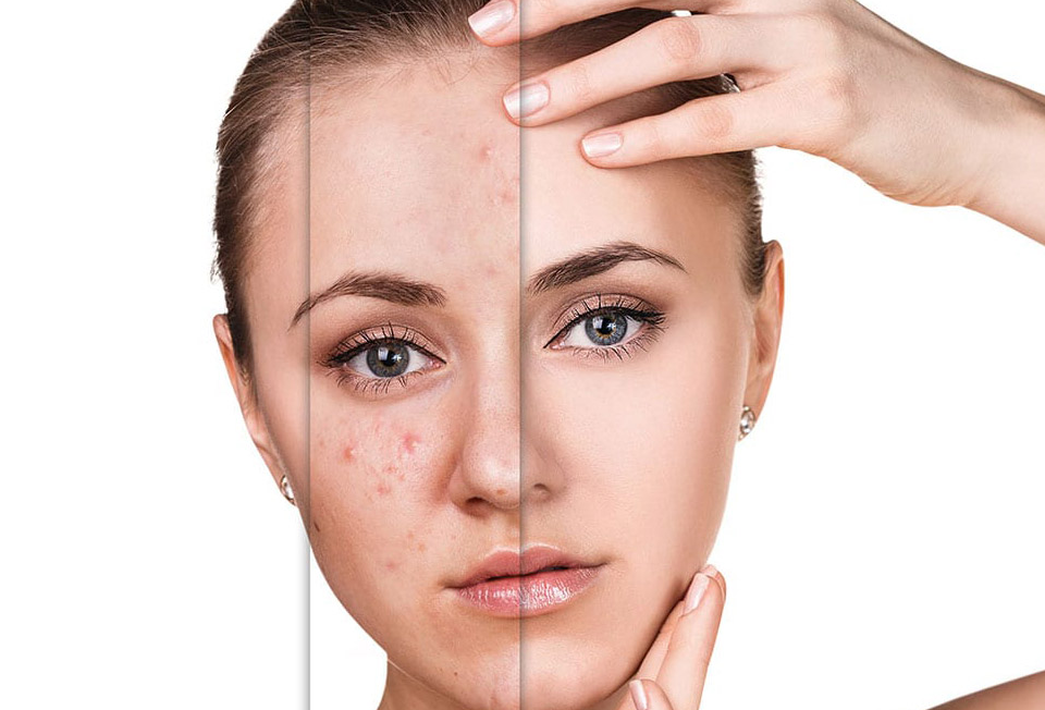 Long-term acne prevention with dermatologist-guided skincare routine