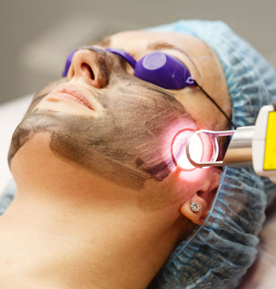 Dermatologist performing carbon peel laser toning treatment for glowing skin