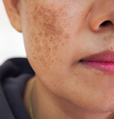 Freckle removal treatment using Q-switched Nd:YAG laser