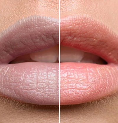 Safe and effective laser treatment to lighten hyperpigmented lips