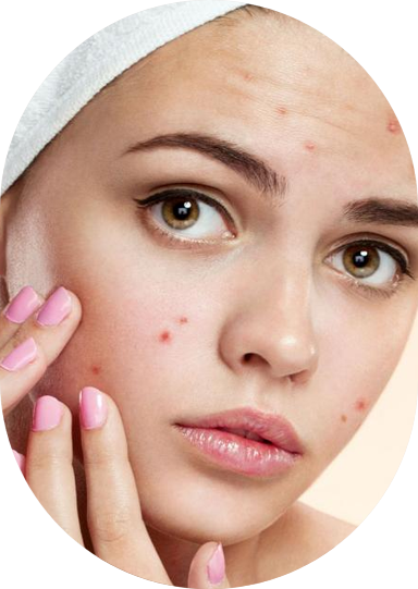 Even skin tone achieved through acne and pigmentation treatment