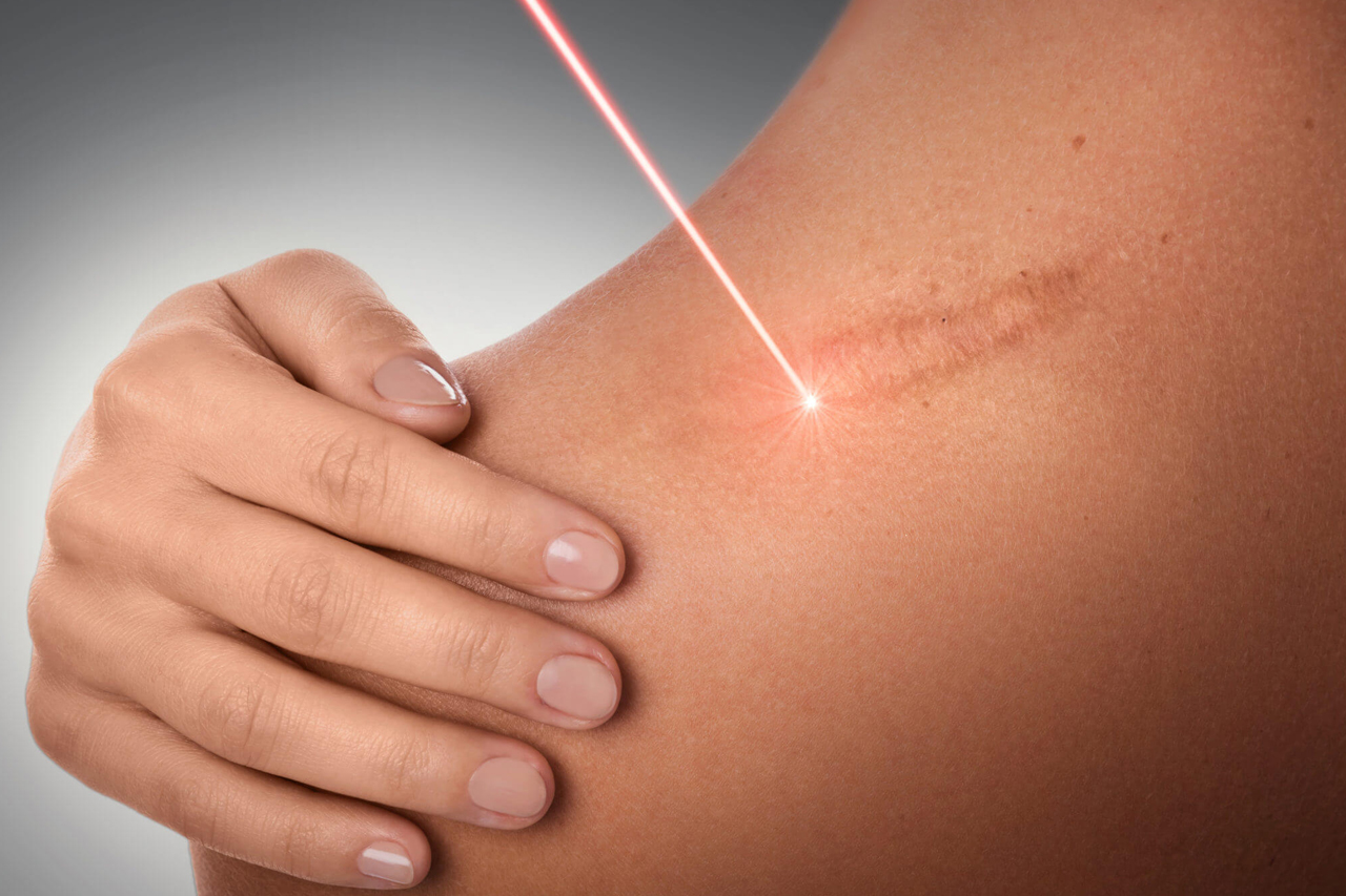 Professional laser scar removal at dermatology clinic in Kochi