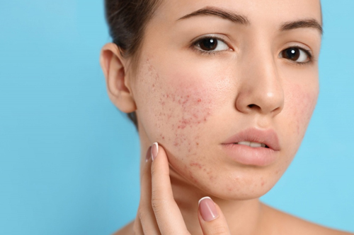 Laser treatment for reducing deep acne scars