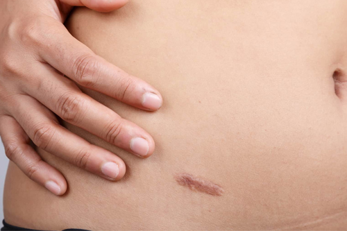 Close-up of post-traumatic scar on skin before treatment