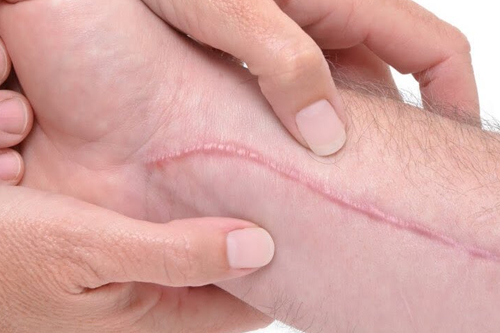 Professional hypertrophic scar management at skin clinic in Kochi