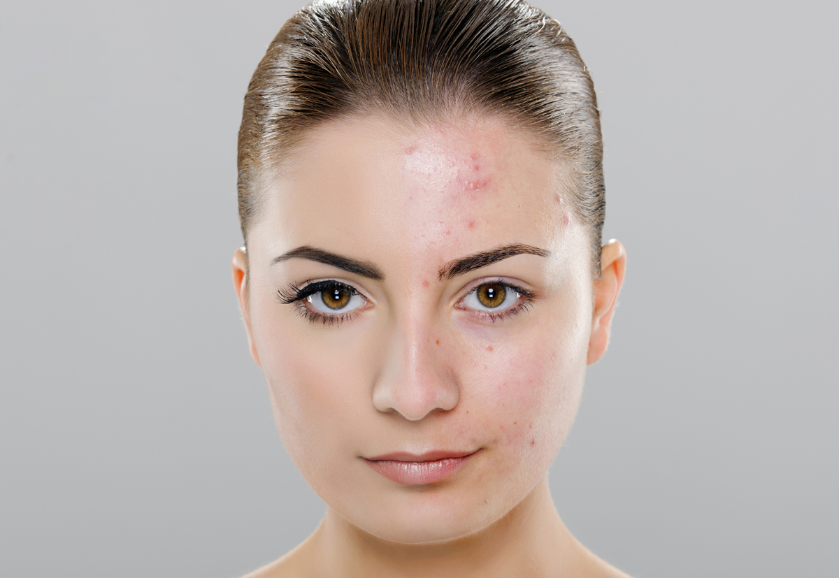 Acne scar treatment combining laser, PRP, and microneedling